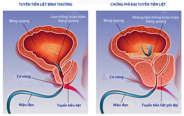 Đông trùng hạ thảo chữa bệnh tiền liệt tuyến