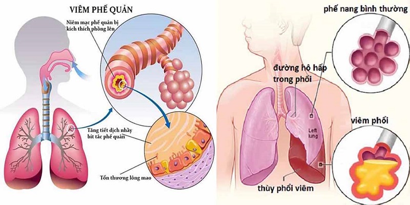 Bất ngờ tác dụng của viên bổ phế Banikha với bệnh nhân viêm phế quản