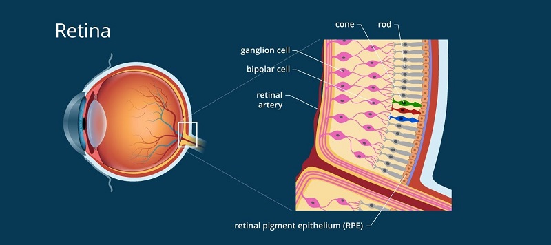 Bệnh võng mạc: Tình trạng tổn thương các mạch máu nhỏ ở đáy mắt