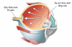 Biến chứng nguy hiểm về mắt ở người tiểu đường: Phòng ngừa bằng cách nào?