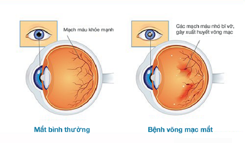 Biến chứng nguy hiểm về mắt ở người tiểu đường: Phòng ngừa bằng cách nào?