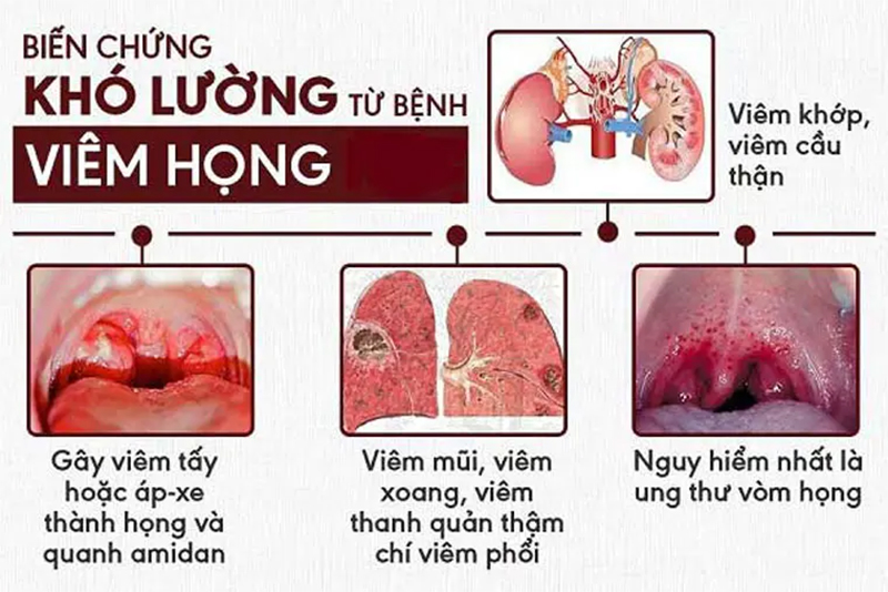 5 biến chứng nguy hiểm của viêm họng và cách phòng ngừa hiệu quả