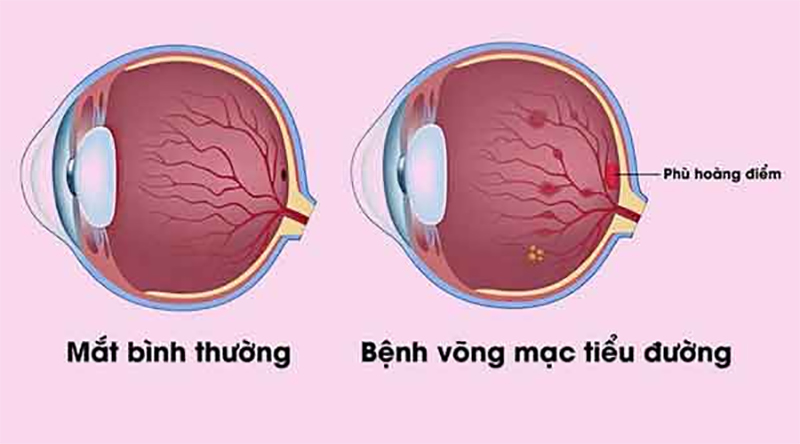 Biến chứng võng mạc đái tháo đường