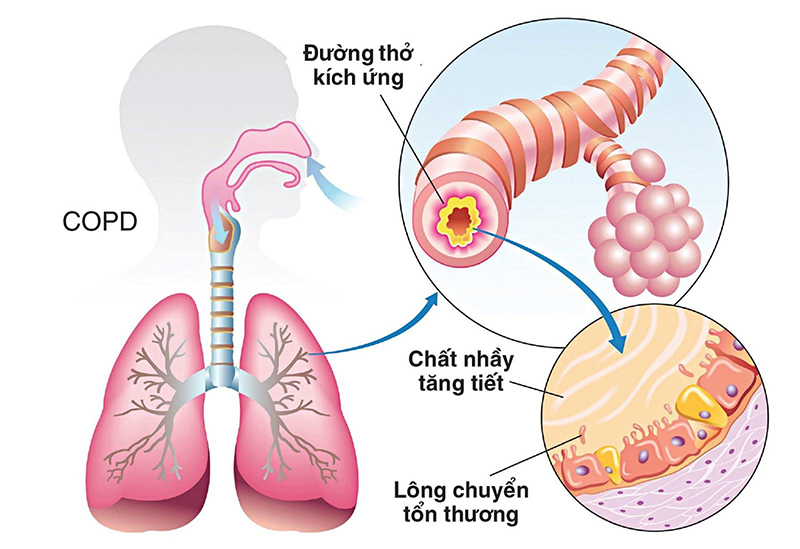 5 triệu chứng điển hình nhất của COPD 