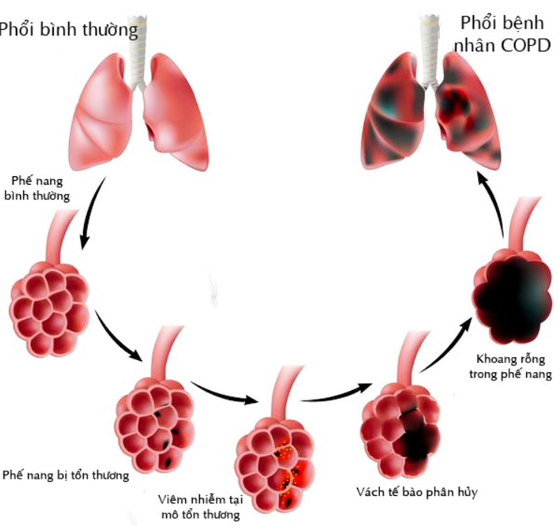 Những biện pháp giúp ngăn ngừa đợt cấp COPD lúc giao mùa