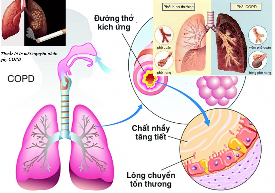 Các đợt cấp COPD 