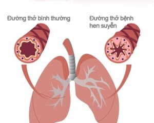 Giảm các triệu chứng hen phế quản mãn tính nhờ thảo dược