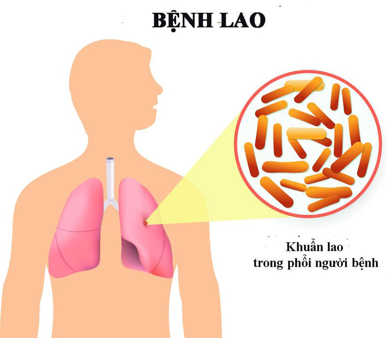 Bí quyết tăng cường chức năng hệ hô hấp sau thời gian bị lao phổi 